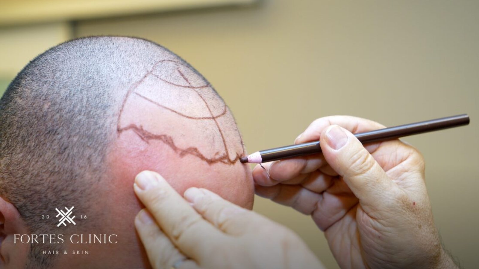 1642517_FortesClinicBlogImagery5_052223