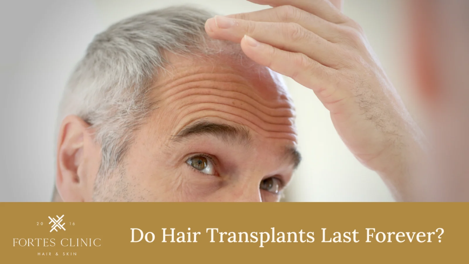 165217_FortesClinicBlogImages_11-Do-Hair-Transplants-Last-Forever-