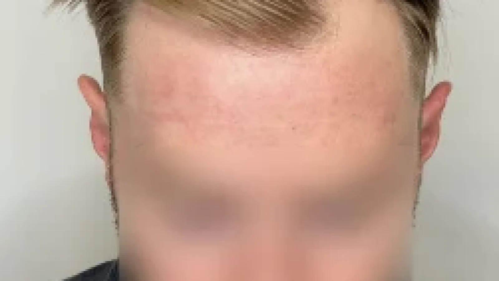 6-months-apart-2200-grafts-FUE-05-Before