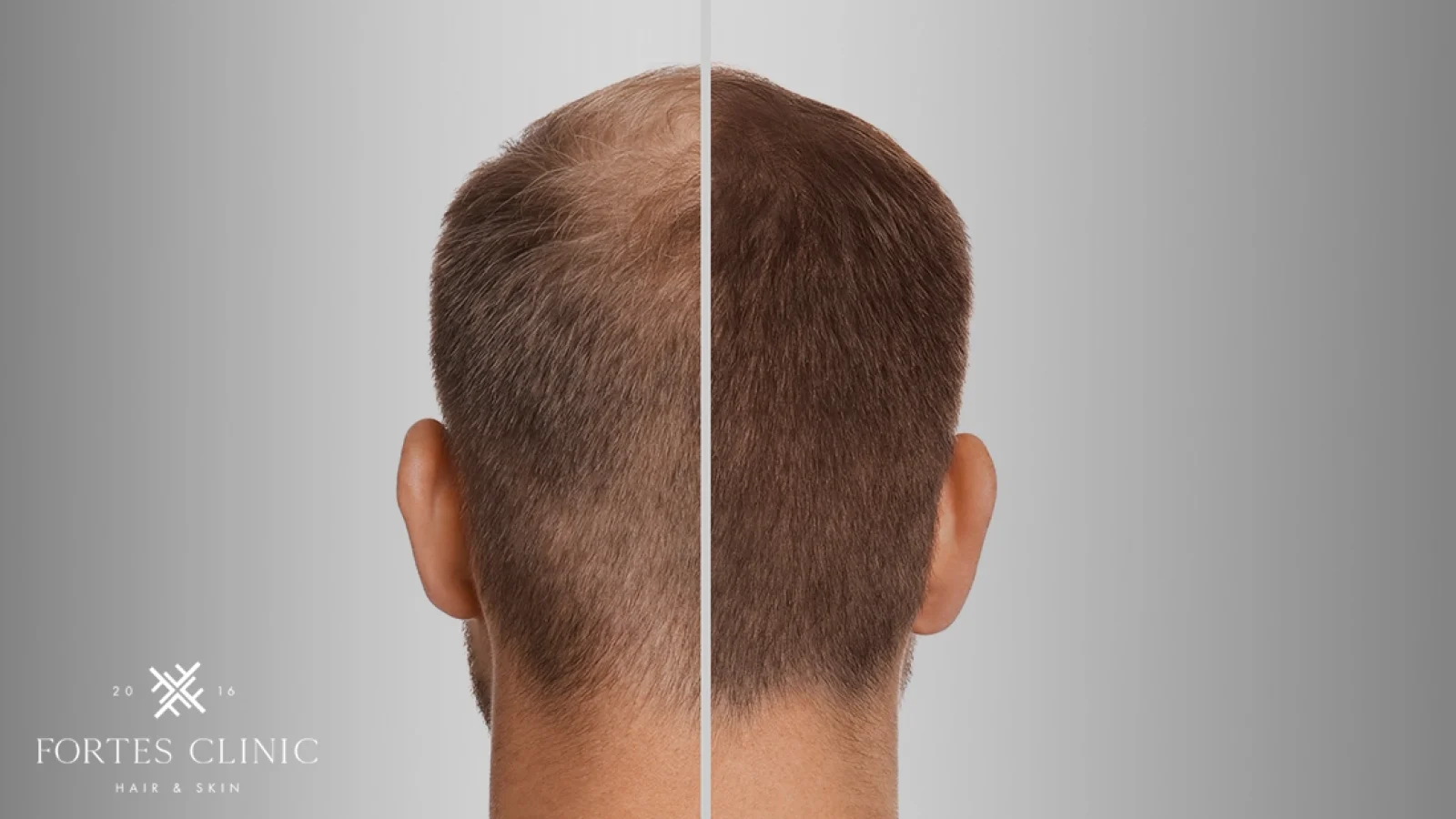 A-Guide-To-Topical-Finasteride