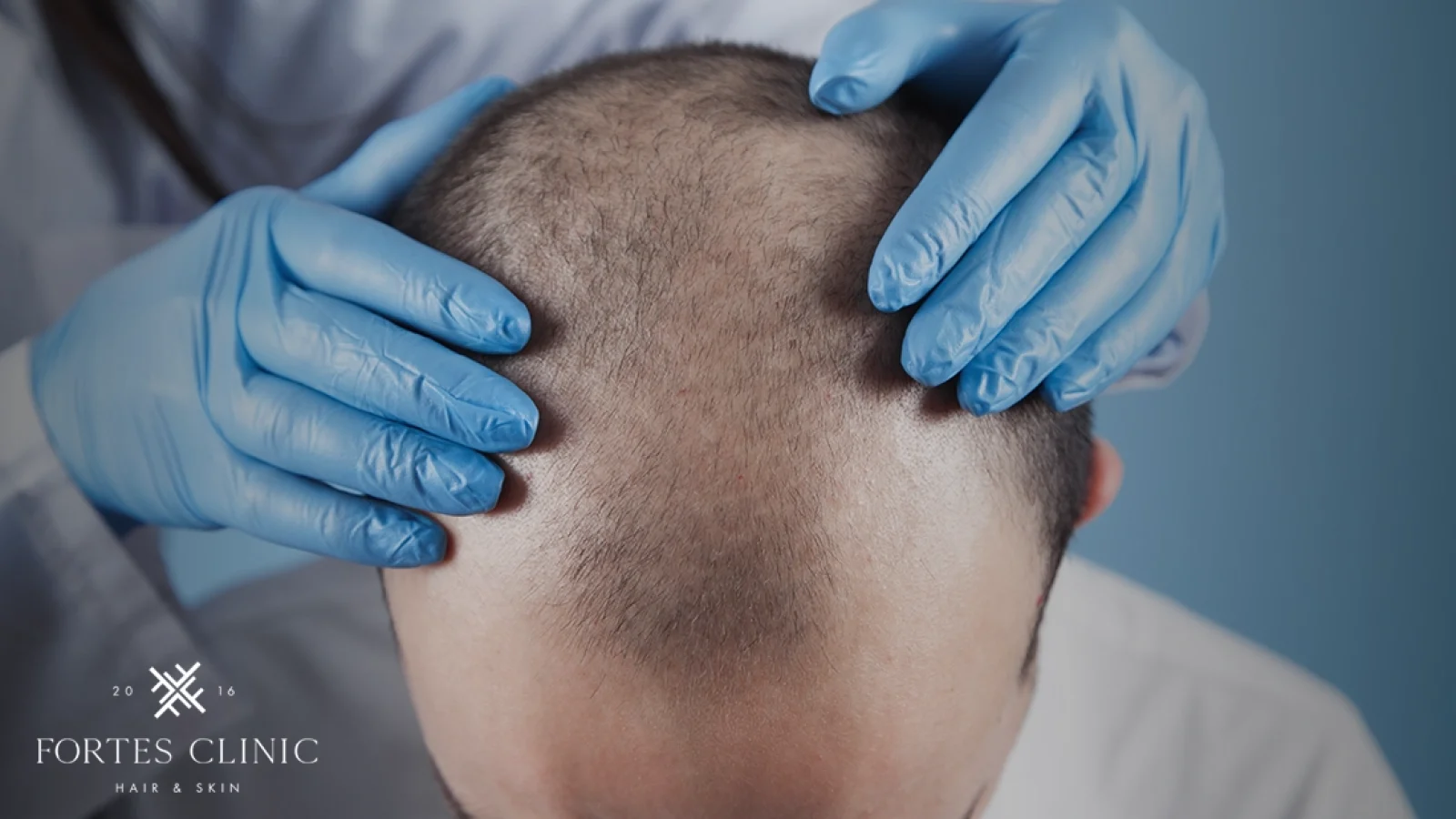 DHT-Blocker-Hair-Loss