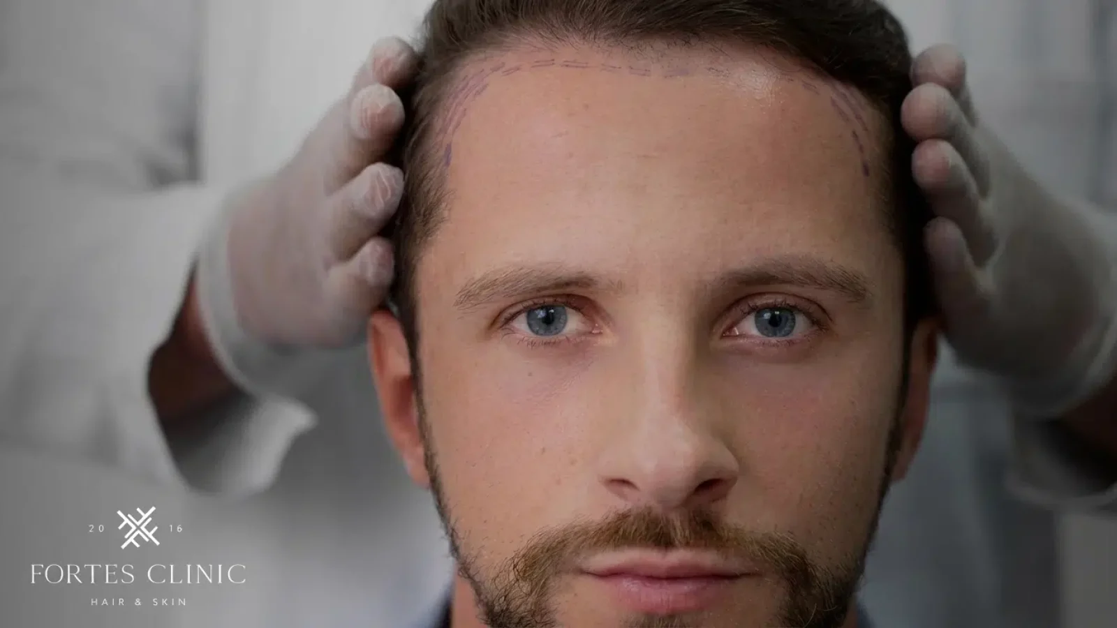 Hair Transplant