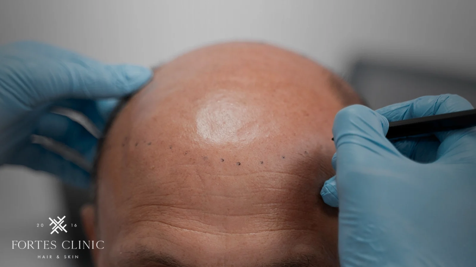 Micro-Scalp-Pigmentation-How-It-Can-Help-Your-Hair-Concerns