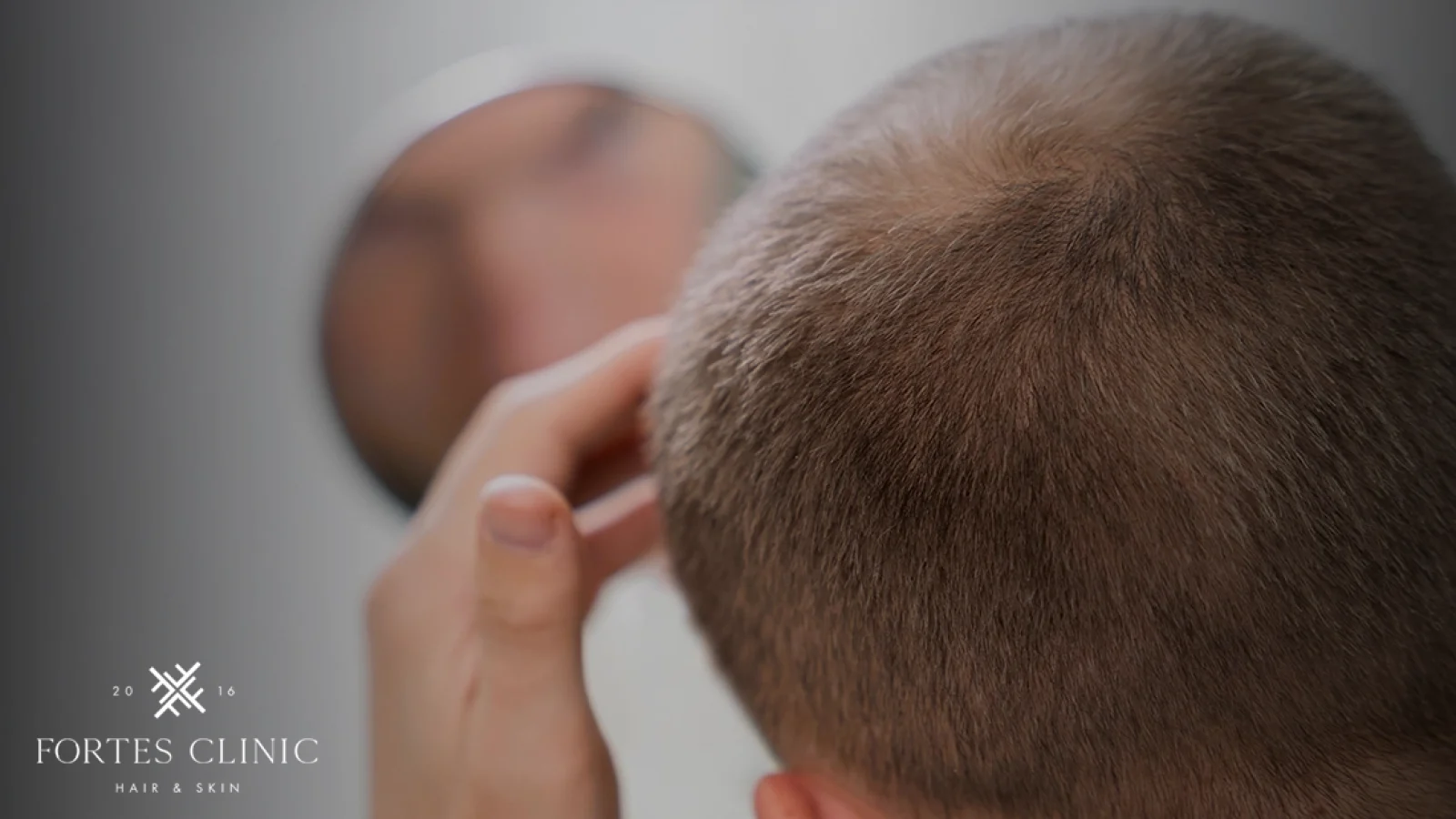 Understanding-Traction-Alopecia-1
