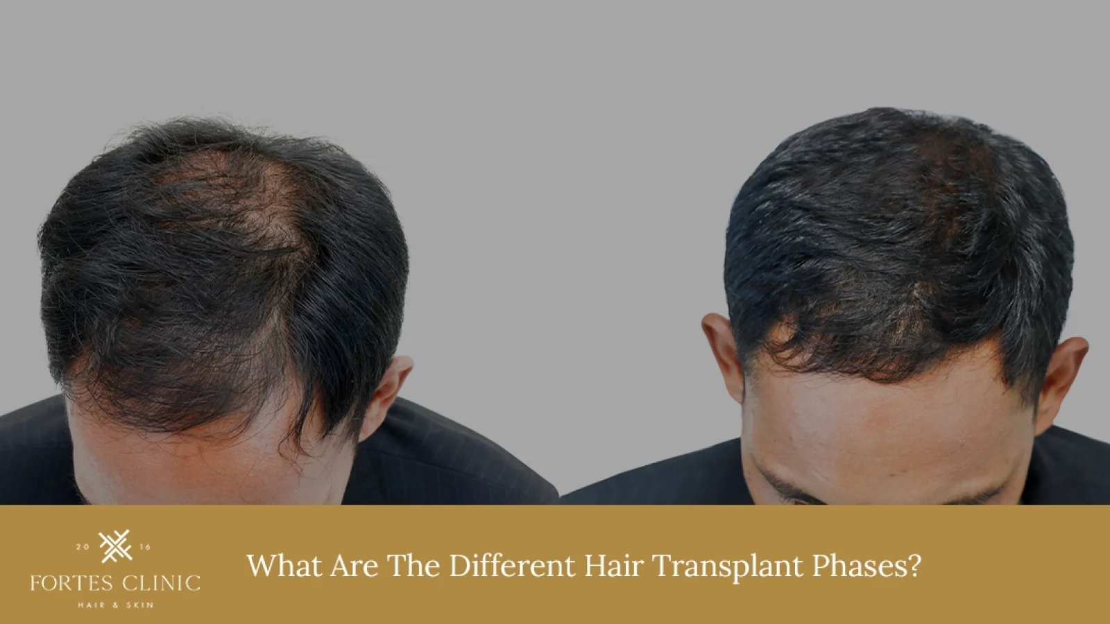 What-Are-The-Different-Hair-Transplant-Phases_