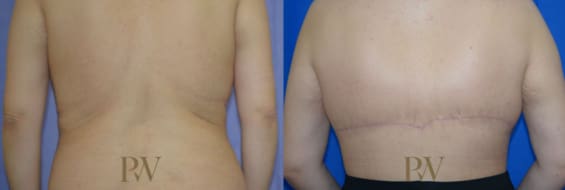 Paul Wilson - Bra Line Back Lift Patient Image 1