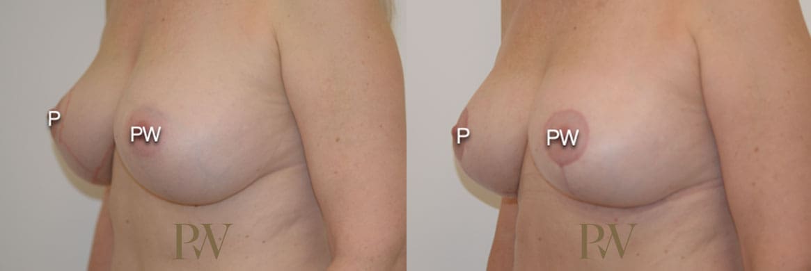 Paul Wilson - Breast Uplift (Mastopexy) Patient Image 3