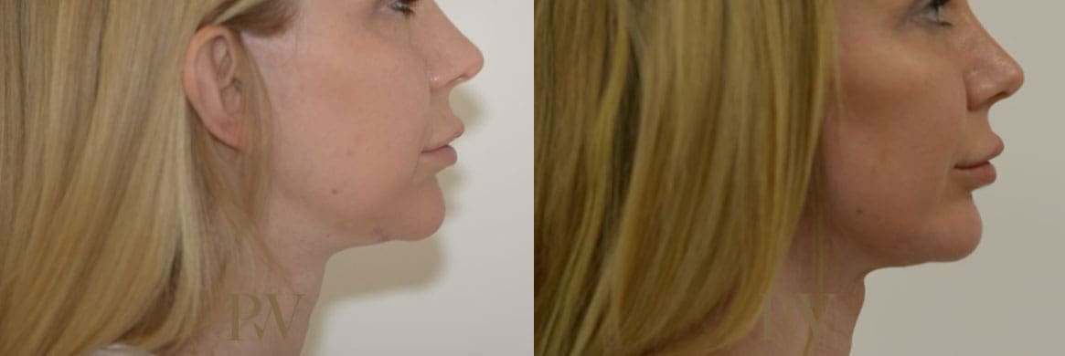 Paul Wilson - Facial Implants Patient Image 9