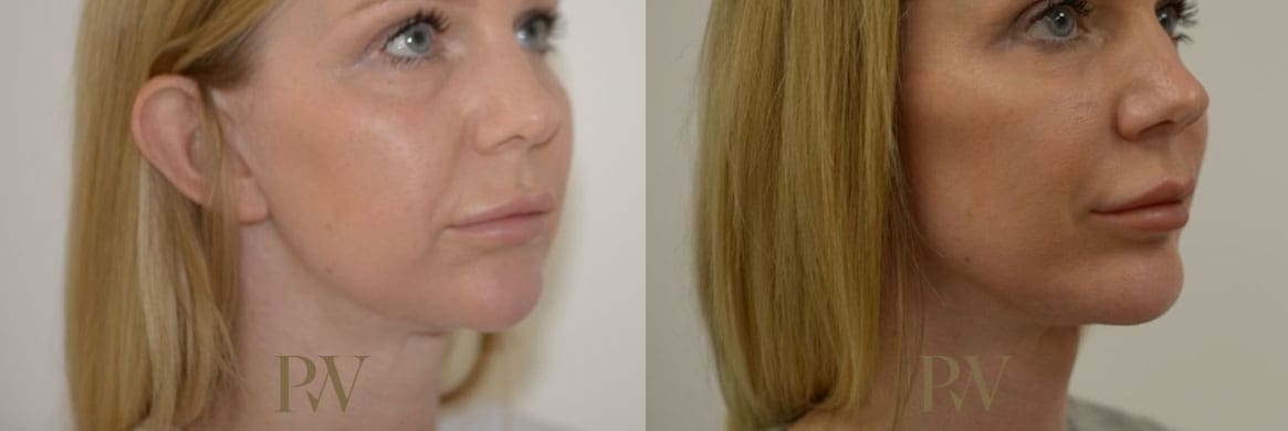 Paul Wilson - Facial Implants Patient Image 11