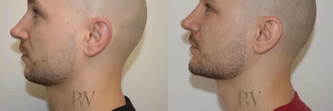 Paul Wilson - Facial Implants Patient Image 13