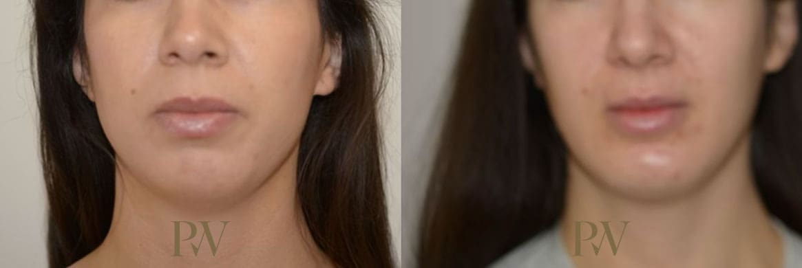 Paul Wilson - Facial Implants Patient Image 17