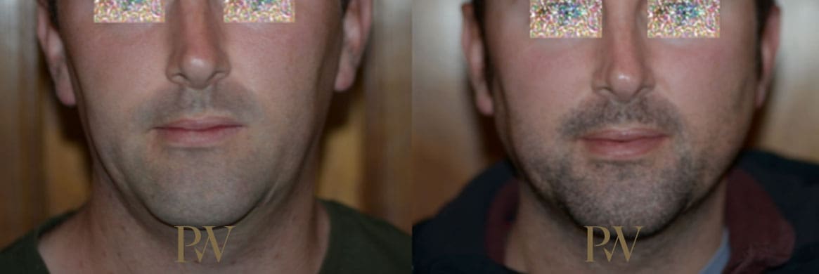 Paul Wilson - Facial Implants Patient Image 18