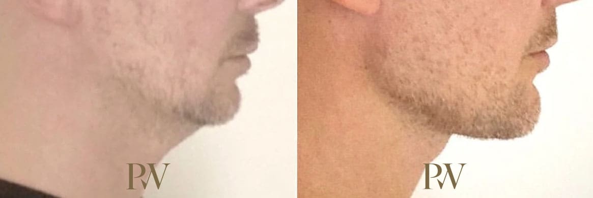 Paul Wilson - Facial Implants Patient Image 2