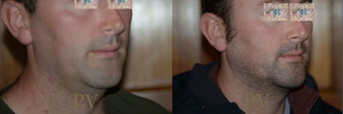 Paul Wilson - Facial Implants Patient Image 20