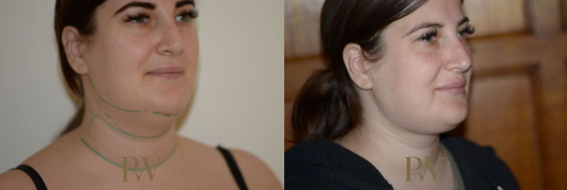 Paul Wilson - Neck Lift Patient Image 16