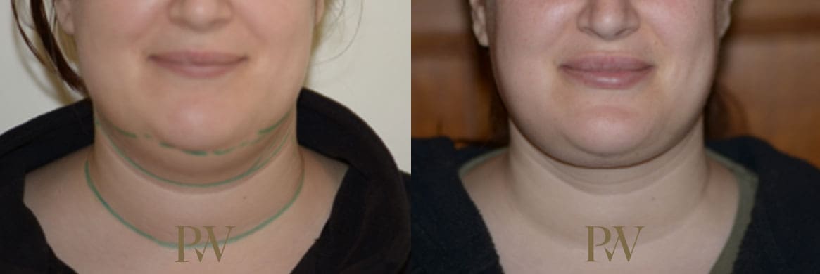 Paul Wilson - Neck Lift Patient Image 6
