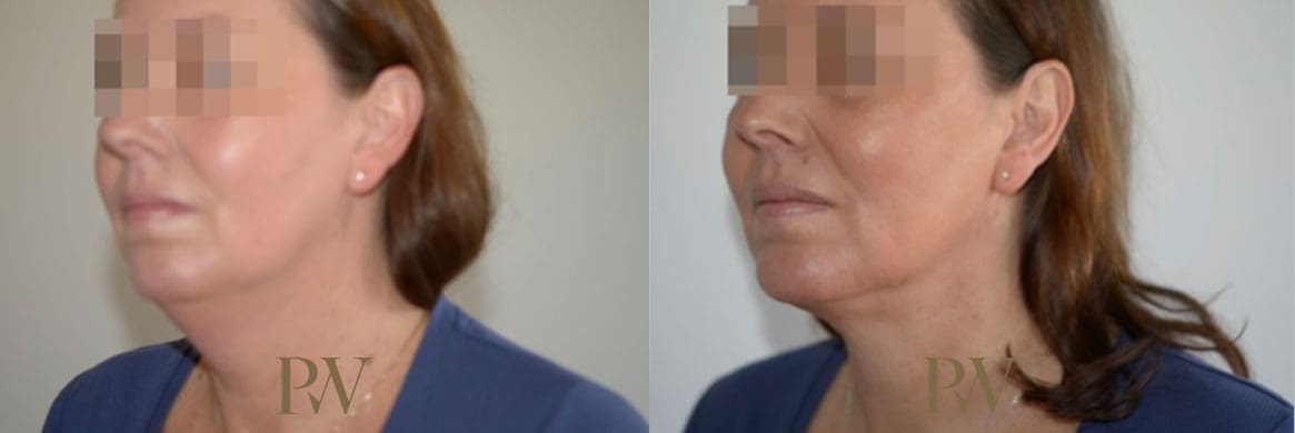 Paul Wilson - Neck Lift Patient Image 7