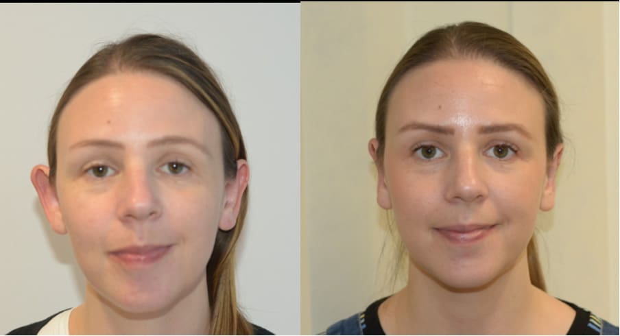 Otoplasty Surgery | Ears Pinned Back Surgery | Otoplasty Procedure