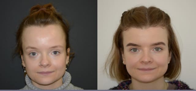 Forehead Reduction Surgery | Foreheadplasty | Hairline Lowering Surgery Cost
